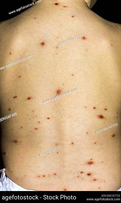 Varicella Virus or Chicken Pox on Babys Back