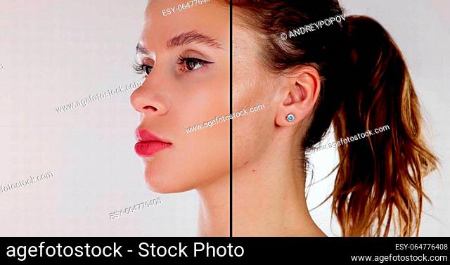 Woman Before And After Face Lift Therapy Injection