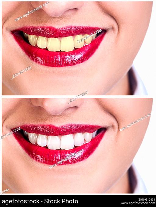 Teeth before and after bleaching treatment. Whitening concept