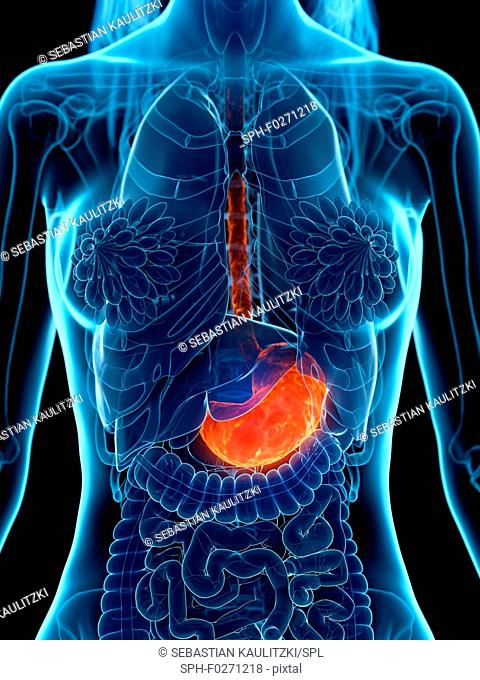 Diseased stomach, illustration