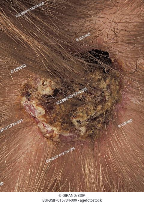 Basal Cell Carcinoma Of The Scalp Stock Photo Picture And Rights