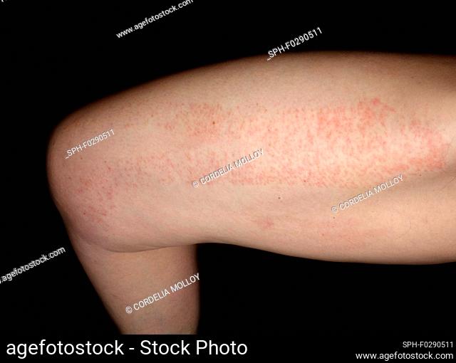 Allergic dermatitis on the thigh of a 51-year-old woman. The rash occurred as a result of an allergic reaction to elastic therapeutic tape applied as...