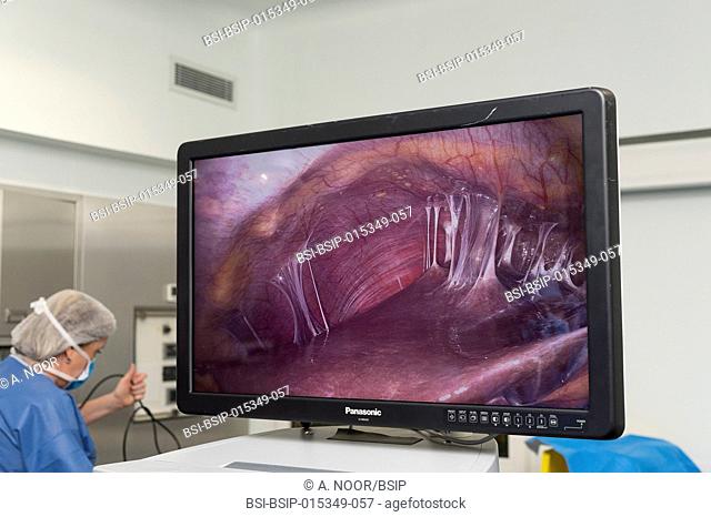 Reportage in the gynecology theatre block in Lenval Clinic, Nice, France. Chlamydia infection. Adhesions between the diaphragm and the liver seen on the screen