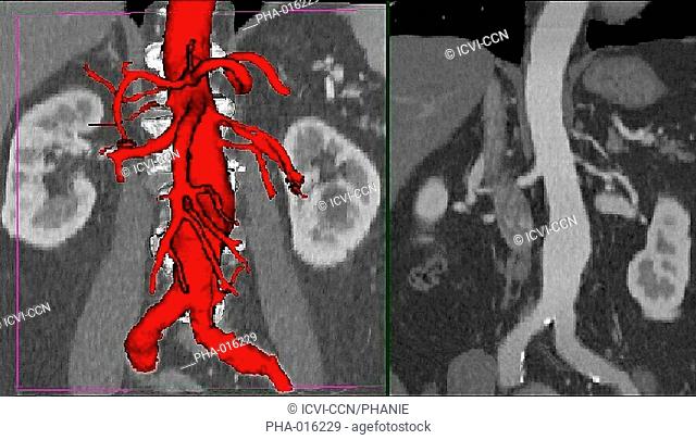 Three-dimensional computed tomographic CT scan reconstruction of an abdominal aortic aneurysm. It appears as swollen bulge located on the abdominal aorta