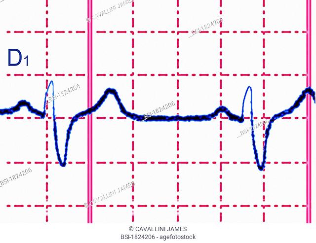 RIGHT BUNDLE-BRANCH BLOCK, ECG<BR> <BR>Complete right bundle branch block: transmission of the electrical impulse is delayed or fails to conduct along the right...