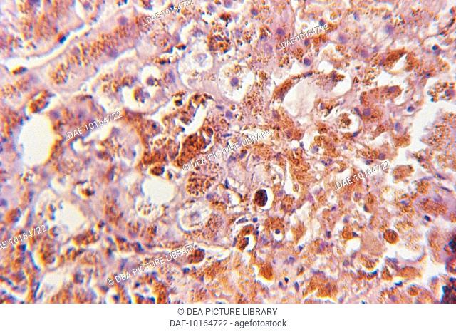 Medicine. Liver tissue of patient suffering from diabetes
