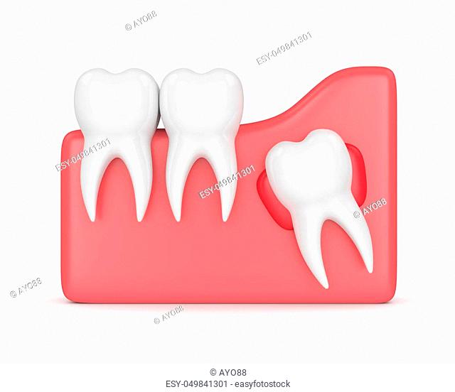 3d render of teeth with wisdom cyst over white background. Concept of different types of wisdom teeth problems