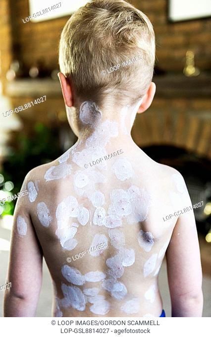 A five year old boy being treated for chicken pox