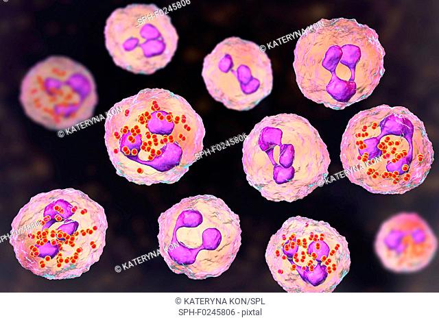 Meningococcal meningitis. Computer illustration showing cerebrospinal fluid containing numerous neutrophils with Neisseria meningitidis bacteria inside (small...