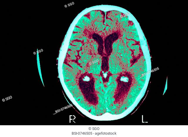 ALZHEIMER'S DISEASE, SCAN<BR>Axial cut-away view. Median portion of dilated third ventricle. Symmetrical dilation of intersections