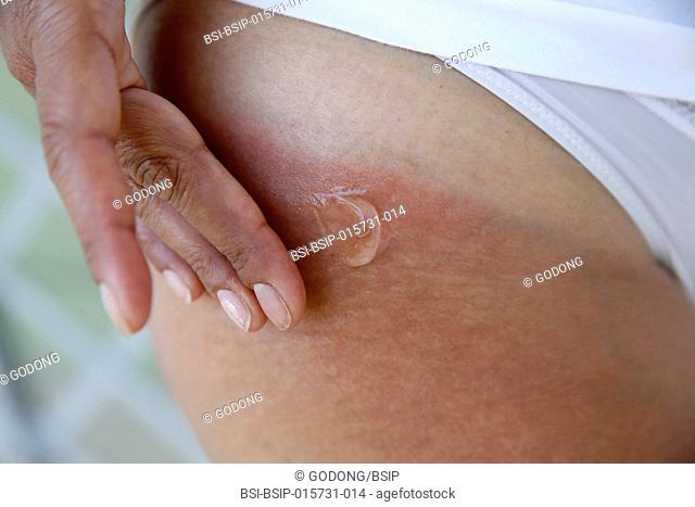 Woman putting gel on sunburnt skin in Salento, Italy
