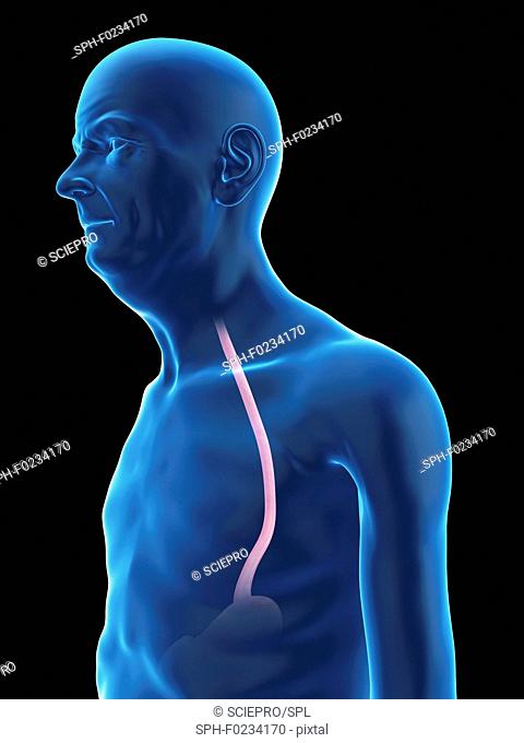 Illustration of an old man's esophagus