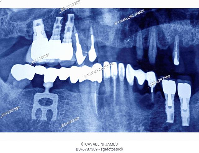 Dental panoramic x-ray , reconstruction of various teeth