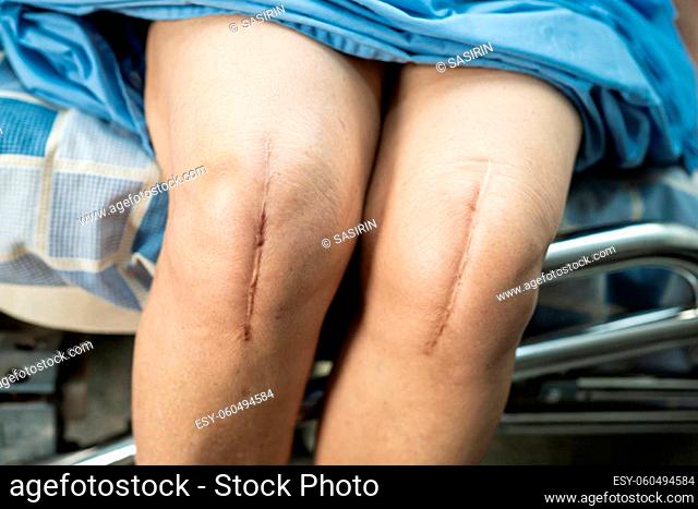 Asian senior or elderly old lady woman patient show her scars surgical total knee joint replacement Suture wound surgery arthroplasty on bed in nursing hospital...