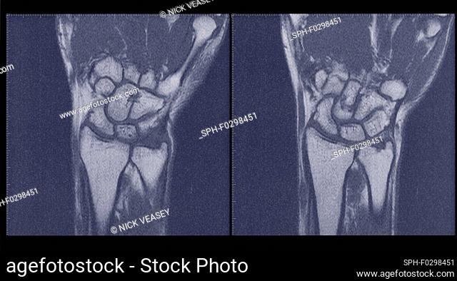 Scans of wrists, MRI