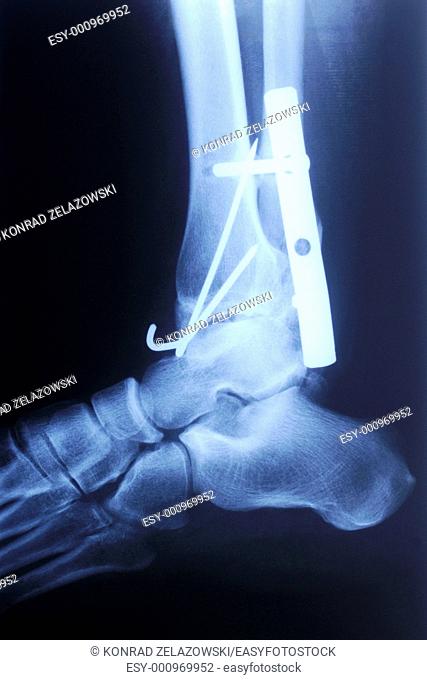 authentic x-ray picture of human fracture ankle with metal plate and screws