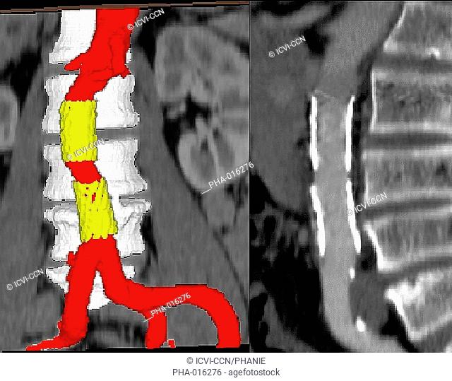 3D computed tomography CT scan of a post-traumatic dissecting aneurism of the abdominal aorta treated with an endoprosthesis yellow