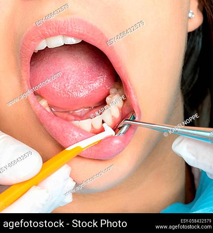 Macro close up of hands doing interdental cleaning on human teeth.Human mouth wide open with interdental brush between teeth