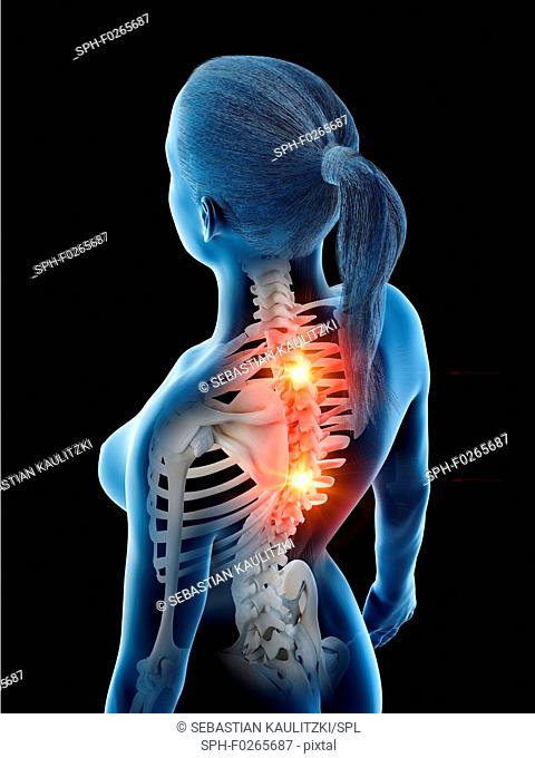 Back pain, conceptual computer illustration