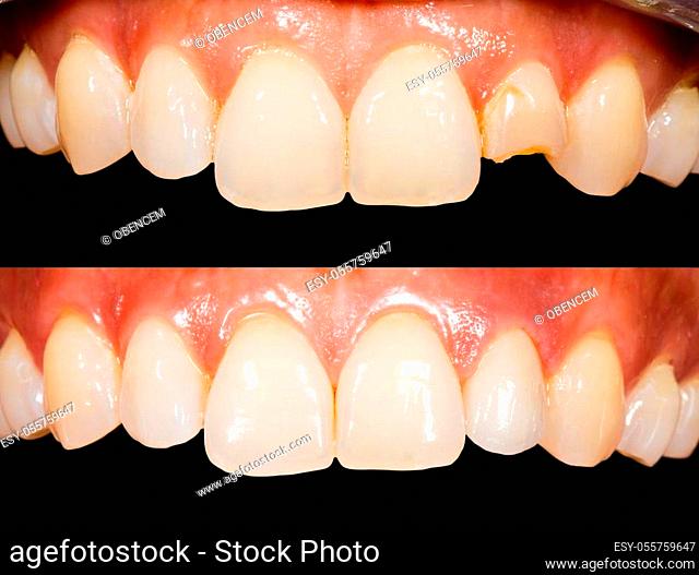 Close up photo of teeth before and after treatment