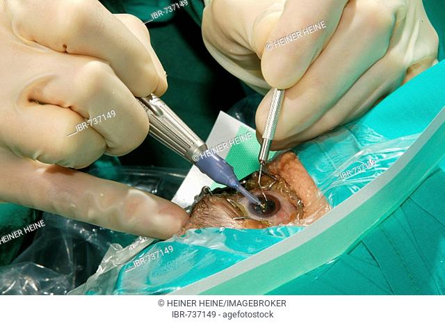 Cataract surgery performed in an operating room in Pietermaritzburg, South Africa, Africa