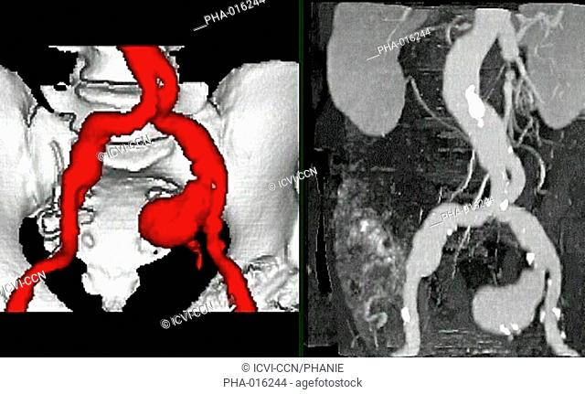 Three-dimensional left and plane right computed tomographic CT scan reconstruction of an internal iliac artery aneurysm. It appears as swollen bulge red