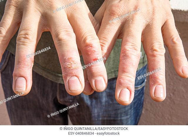 close up of man showing his hand fingers with eczema in skin