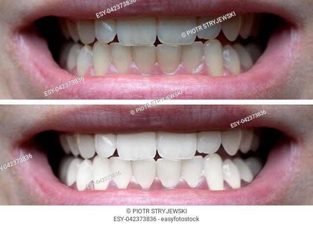 Closeup of woman's teeth before and after whitening