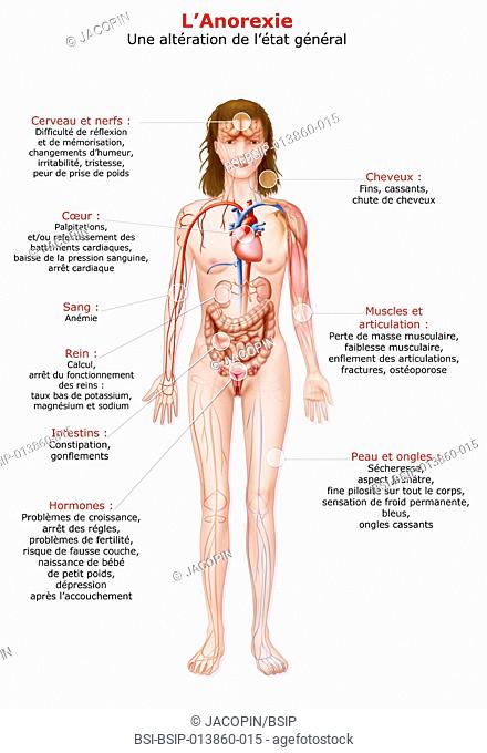 Illustration of the organs affected by, and the consequences of, anorexia. affected organs and consequences : -brain and nerves : difficulty in thinking and...
