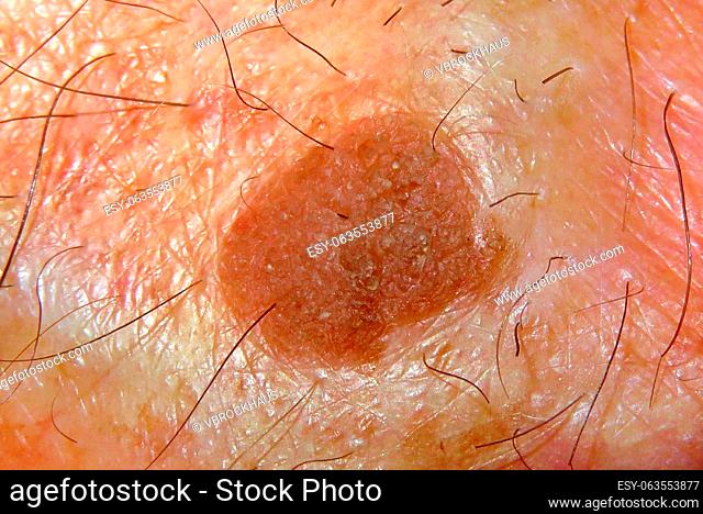 Flat Seborrheic keratosis on back of the hand. A seborrheic keratosis is a non-cancerous (benign) skin tumour that originates from cells, namely keratinocytes
