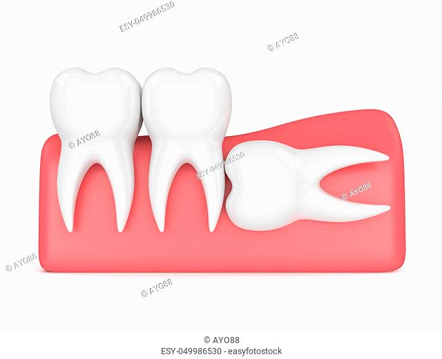 3d render of teeth with wisdom horizontal impaction over white background. Concept of different types of wisdom teeth impactions