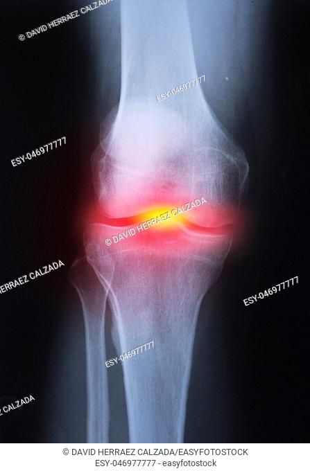 Medical x-ray knee joint image with arthritis Gout , Rheumatoid arthritis , Septic arthritis , Osteoarthritis knee