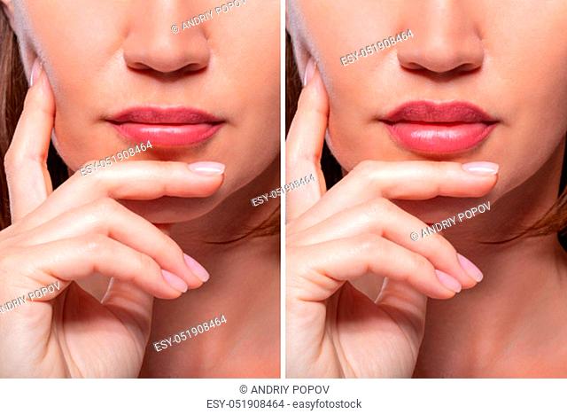 Woman Before And After Lips Augmentation Procedure