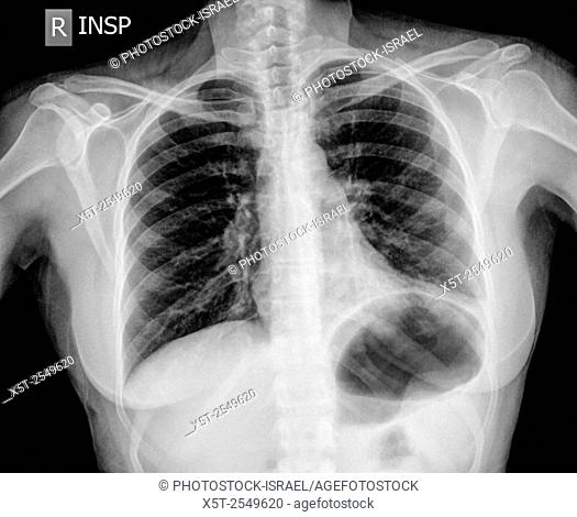 Chest x-ray of a 30 year old female patient with signs of pneumonia in the Left Lower Lobe (LLL) of her lung Front View