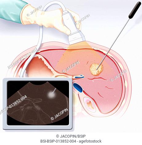 Illustration of the ablation of a tumor in the liver by radiofrequency ablation. Under ultrasound monitoring, the doctor inserts a fine electrode through the...