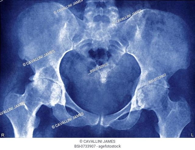 ARTHROSIS OF THE HIP, X-RAY Hip arthrosis -Cowarthrosis of the hips - x-ray of the hips in front view