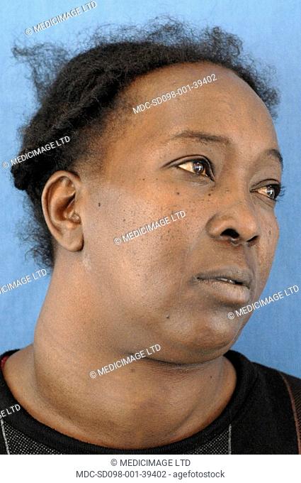The patient has goitre, a swelling in the neck just below the Adams apple larynx due to an enlarged thyroid gland