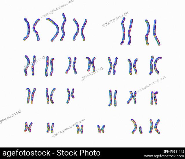 Karyotype of Prader-Willi syndrome, computer illustration. This is a genetic disorder caused by the deletion of a region on chromosome 15 inherited from a...