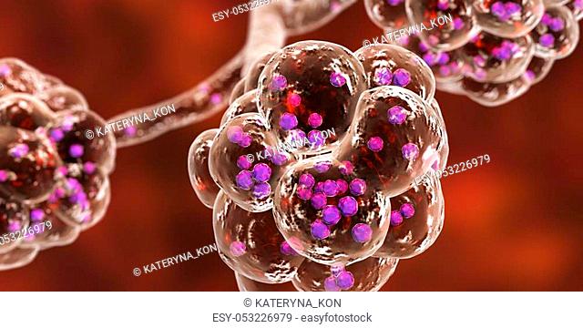 Staphylococcal pneumonia, medical concept. 3D illustration showing bacteria Staphylococcus aureus inside alveoli