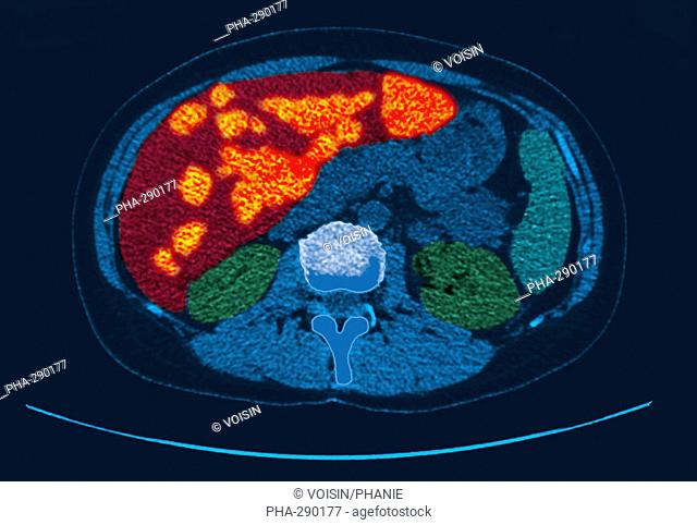 CT scan through a female patient suffering from secondary liver cancer, This cancer has spread from a primary tumour in the breast