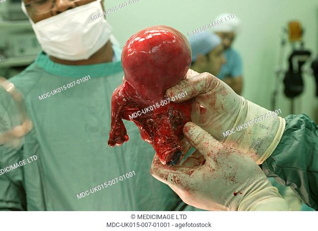 The bulbous, distended uterus is completely removed./nThe corpus and cervix uteri can both be seen in this shot, along with one of the fallopian tubes on the...