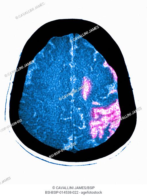 Cerebral atrophy. Parietal cortico-sub-cortical atrophies (aftereffects of left, frontoparietal parenchymal ischemia), seen on a radial cross-section brain CT...