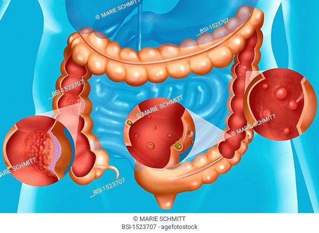 Illustration of the main pathologies of the colon : colorectal cancer on the left, diverticula in the middle and polypes on the right