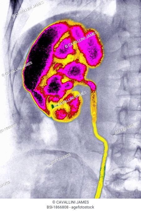 Ascending nephritis by microbial urinary infection, visualized by an urography of the right kidney