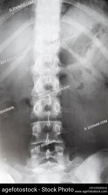 front view of human spine in torso on X-ray image