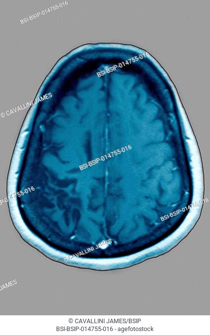 Cerebral atrophy. Cortical-sub-cortical parietal atrophy as a result of an ischemic stroke, seen in a radial section MRI