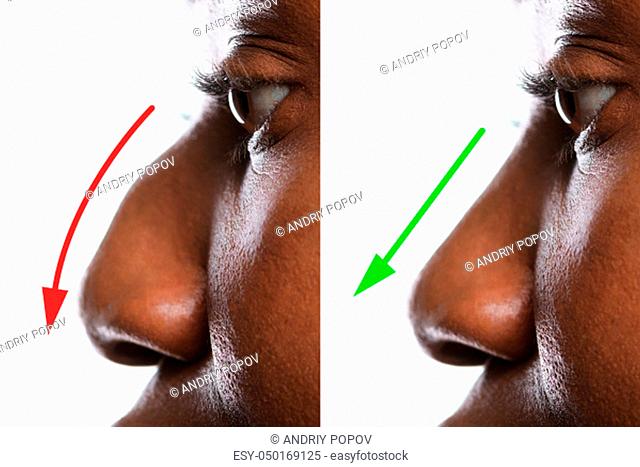 Woman's Nose Before And After Plastic Surgery With Red And Green Arrows
