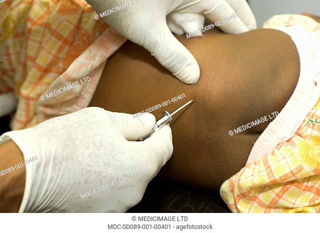 A patient undergoing a lumbar puncture spinal tap. This is a procedure where a sample of cerebrospinal fluid is obtain from the lumbar spine via the space...