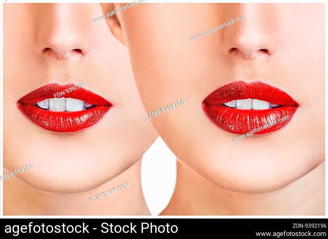 Red lips of young woman before and after filler injections