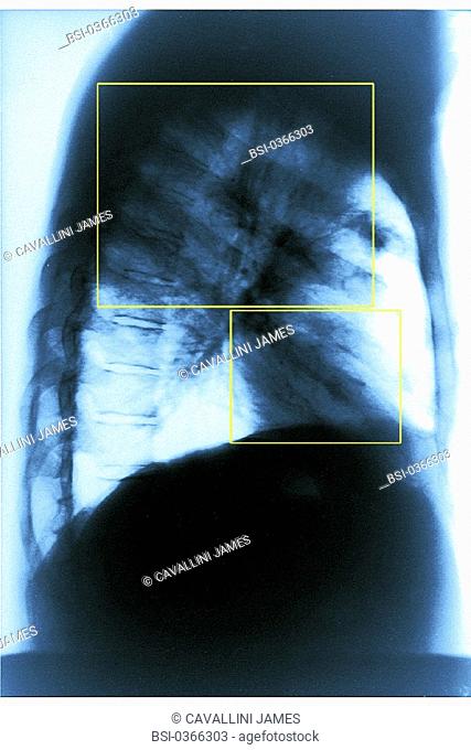 ASBESTOSIS, X-RAY<BR>Asbestosis is a form of pneumoconiose caused by inhaling asbestos fibers. Here, it caused lung cancer. X-ray of lung's profile